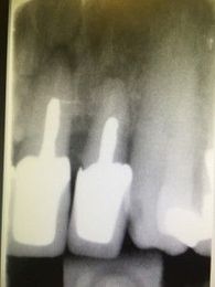 Debriding the sockets and provide Essix: Thoughts on Approach?