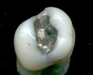 Dental amalgam controversy
