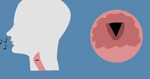 Fresh Voices: Researchers Grow New Vocal Cords From Cells