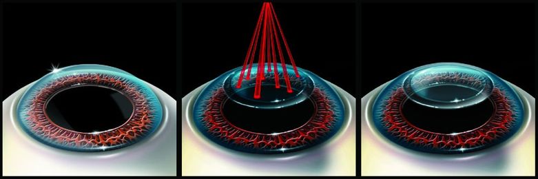 Alternative Options To Lasik