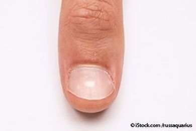 10 Nail Symptoms and What They Mean for Your Health