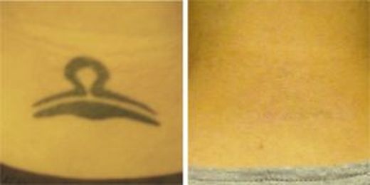 Myths about Laser Tattoo Removal