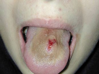 Why oral piercing is a bad idea