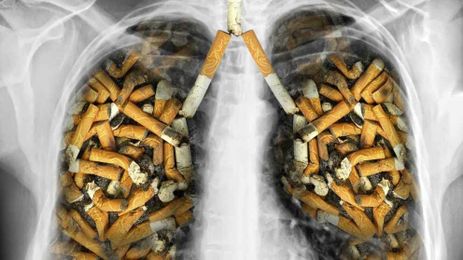 Smokers Who Quit More Than 15 Years Ago Need Screening