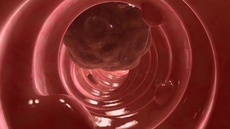 10 ways to prevent colon cancer