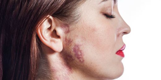 The Science Behind The Port-Wine Birthmark