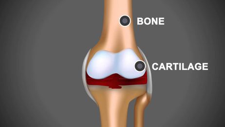 The Ins and Outs of Joint Bleeds