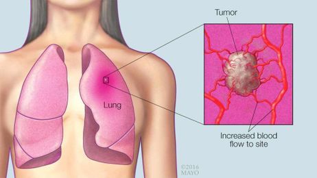 Mayo Clinic Q and A: Pinpointing A Specific Cause of Lung Cancer Isn’t Possible