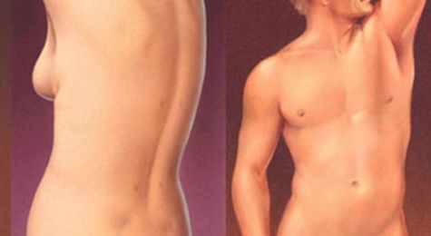 Benefits of Ultrasound Liposuction