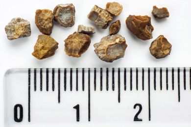 A Proactive Approach to Kidney Stone Prevention