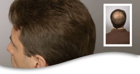 Hair Replacement Restores Your Natural Appearance