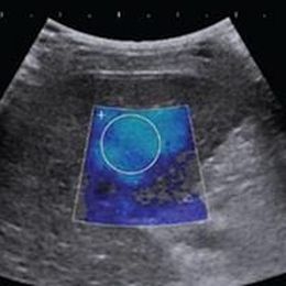 Shear-wave elastography can predict esophageal varices