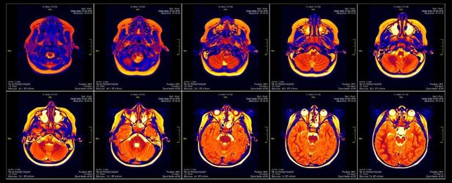 A Bug in FMRI Software Could Invalidate 15 Years of Brain Research
