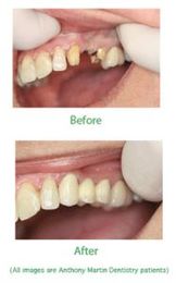 What Are Dental Bridges and Who Should Get Them?