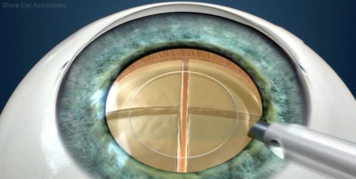 What type of anesthesia do they use for cataract surgery?