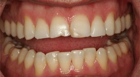 A quick fix as a first step