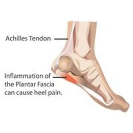 Hamstring Tightness and Plantar Fasciitis