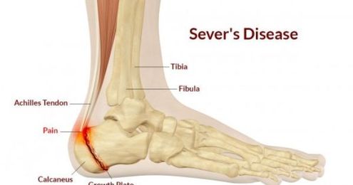 Understanding Sever's Disease and Gymnastics