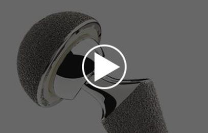 Joint Surgery Utah –