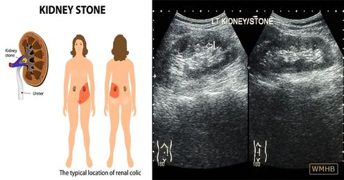Kidney Stones? Don't Ignore These 7 Signs!