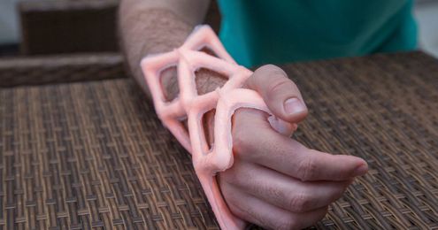 Algorithms helped design this smart update on the orthopedic cast