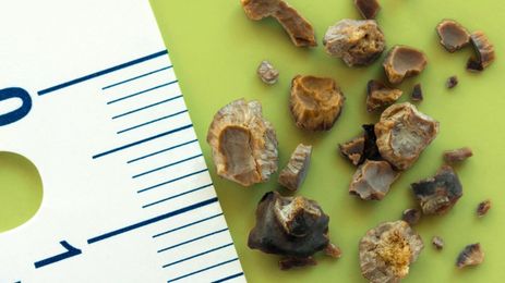Everything You Need To Know About Kidney Stones