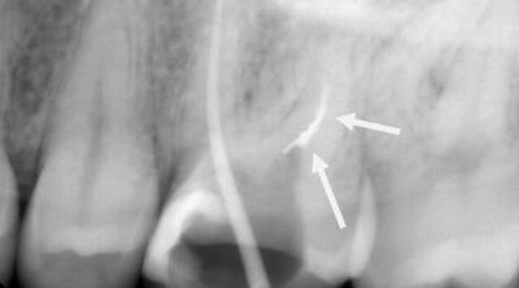 Learning from root canal complications