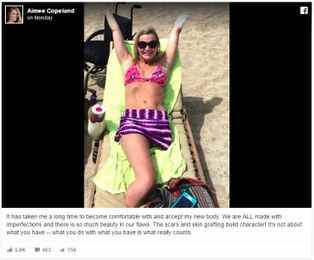 Flesh-eating bacteria survivor would do it all again