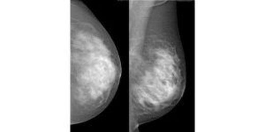 14 Tips for Less Painful Mammograms