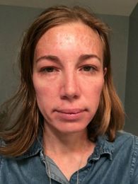 A journey with the Pearl™ Treatment