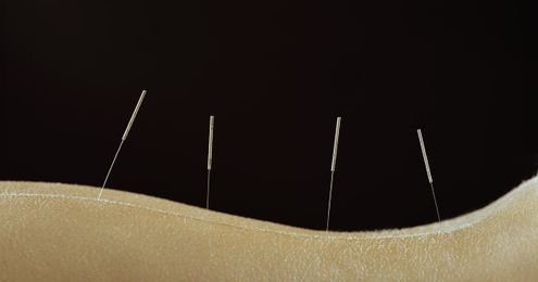Three Things You Didn't Know Acupuncture Can Treat