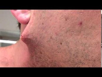 Guys "Pimple" Turned Out To Be Something Else