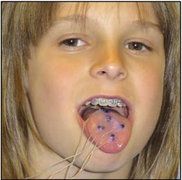 Opti-Speech Clinical Trial helping remove speech impediments