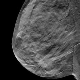 Adding DBT to breast screening helps BI-RADS accuracy