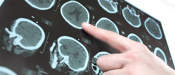 Cutting-edge work is underway at VA’s Parkinson’s disease centers