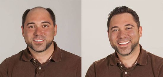 Three Causes of (and Solutions for) Men's Hair Loss