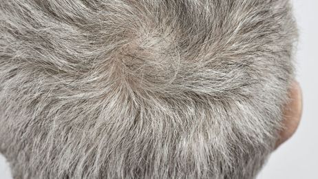 Men who are going gray may have higher risk of heart disease