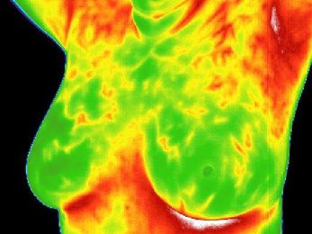FDA issues warning letter to “holistic” practitioner offering thermography for breast cancer detection
