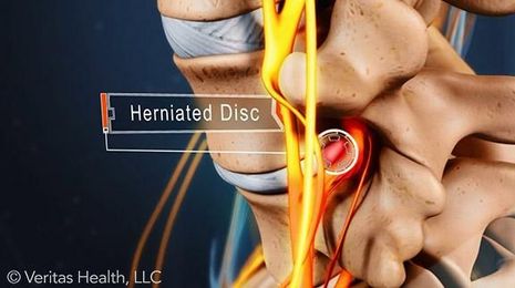 Can Herniated Discs Heal on Their Own?