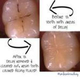 The Pros and Cons of Dental Bonding