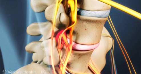 3 Insights for Patients with Disc Problems