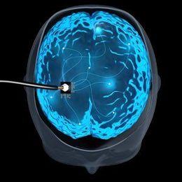 Is Stroke Rehabilitation Possible with Electrode Implants?