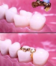 Restoring Your Smile With Dental Inlays And Onlays