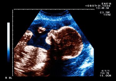 Fetuses Respond To Face-Like Patterns, Study Suggests
