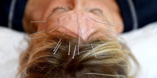 The benefits of acupuncture