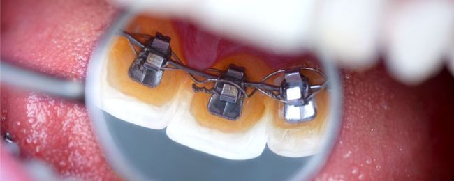 Lingual Braces vs. Ceramic Braces: The Best for Teeth Alignment