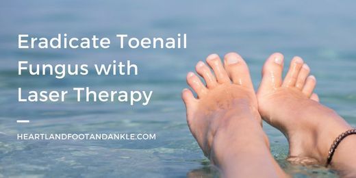 Why Laser Therapy for Fungal Nails is Right for You!