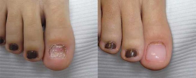 Fix Fungal Nails (Before It Gets Even Hotter)