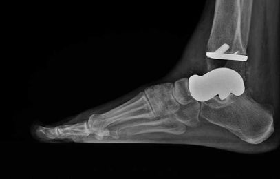 3D Printed Bone Replica Helps Pilot with Ankle Cysts Keep Flying High