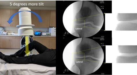 Knee Stem Cell X-ray Results: Watch Me Grow New Cartilage in Seconds!